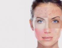 Как правильно определить свой тип кожи лица Какой тип кожи лица тест